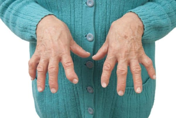 Marijuana Benefits for Arthritis. Women showing her hands.